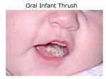 Treatment of Oral Thrush